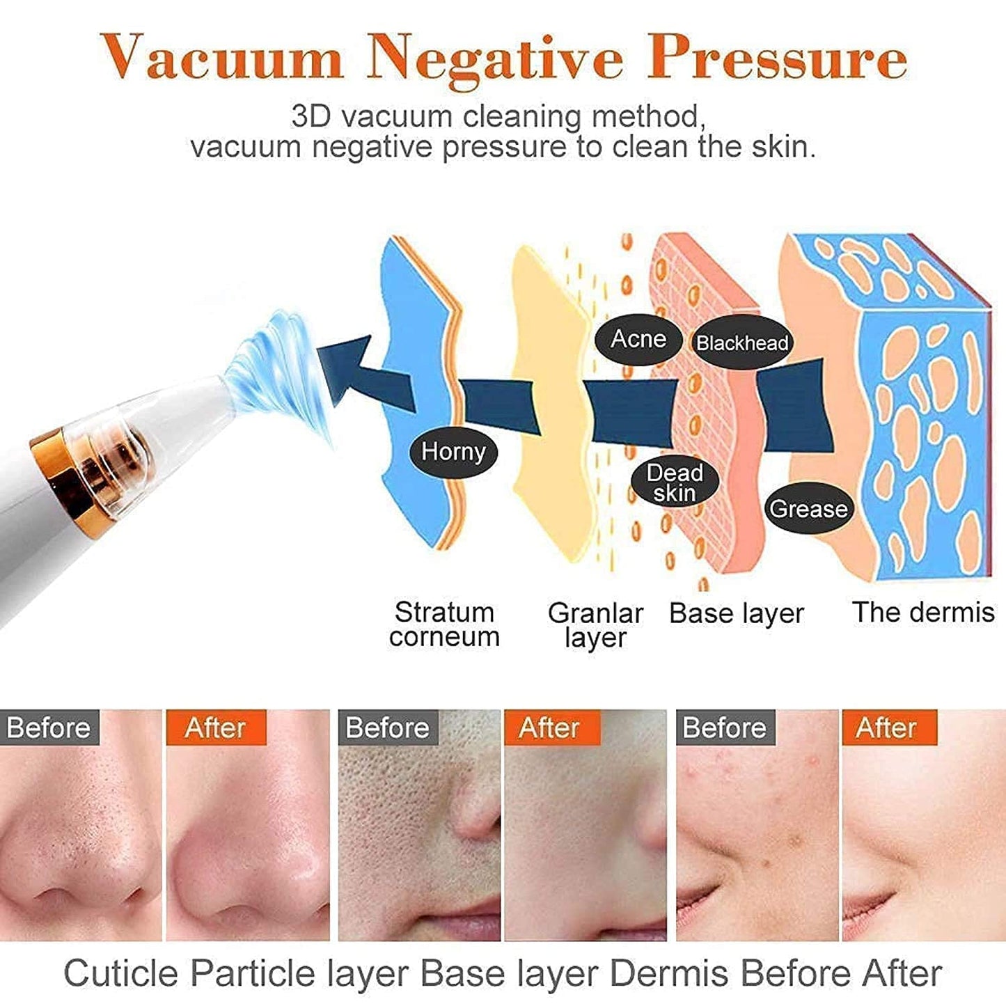 DermaGlow™ Pore Vacuum 6-in-1 Pore Vacuum | Professional Blackhead & Acne Remover